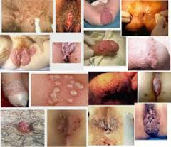penyakit ketuat atau kutil dikemaluan kelamin / di area dubur / anus / benjolan / kondiloma akuminata / jengger ayam pada pria dan wanita penyakit ketuat atau kutil dikemaluan kelamin / di area dubur / anus / benjolan / kondiloma akuminata / jengger ayam pada pria dan wanita
