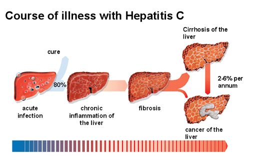  Hepatitis C  How is hepatitis C spread? Hepatitis C is spread primarily through contact with infected blood. Less commonly, it can spread through sexual contact and childbirth.  Who is at risk for hepatitis C? People most likely to be exposed to the hepatitis C virus are • injection drug users • people who have sex with an infected person • people who have multiple sex partners • health care workers • infants born to infected women • haemodialysis patients • people who received a transfusion of blood or blood products before July 1992, when sensitive tests to screen blood donors for hepatitis C were introduced • people who received clotting factors made before 1987, when methods to manufacture these products were improved  How can hepatitis C be prevented? There is no vaccine for hepatitis C. The only way to prevent the disease is to reduce the risk of exposure to the virus. Reducing exposure means avoiding behaviours like sharing drug needles or personal items such as toothbrushes, razors, and nail clippers with an infected person.  Hepatitis C Homeopathy Treatment  Symptomatic Homeopathy works well for Hepatitis, So its good to consult a experienced Homeopathy physician without any hesitation.   Whom to contact for Hepatitis C Treatment  Dr.Senthil Kumar Treats many cases of Hepatitis, In his medical professional experience with successful results. Many patients get relief after taking treatment from Dr.Senthil Kumar.  Dr.Senthil Kumar visits Chennai at Vivekanantha Homeopathy Clinic, Velachery, Chennai 42. To get appointment please call 9786901830, +91 94430 54168 or mail to consult.ur.dr@gmail.com,    For more details & Consultation Feel free to contact us. Vivekanantha Clinic Consultation Champers at Chennai:- 9786901830  Panruti:- 9443054168  Pondicherry:- 9865212055 (Camp) Mail : consult.ur.dr@gmail.com, homoeokumar@gmail.com   For appointment please Call us or Mail Us  For appointment: SMS your Name -Age – Mobile Number - Problem in Single word - date and day - Place of appointment (Eg: Rajini – 30 - 99xxxxxxx0 – Hepatitis, – 21st Oct, Sunday - Chennai ), You will receive Appointment details through SMS
