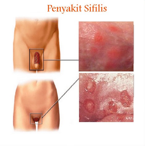 Fc2user01928g Blog Bintik Bintik Merah Dan Gatal Pada Vagina