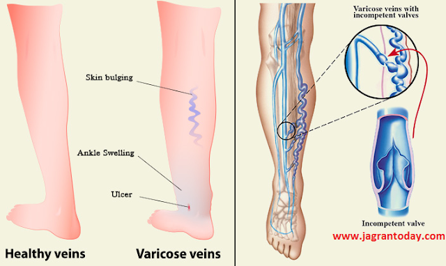Varicose Veins Kya Hai or Isse Bachav ke Upay | वेरीकोज वेंस क्या है और  इससे बचाव के उपाय | What is Varicose Veins and How to Protect form It |  Jagran