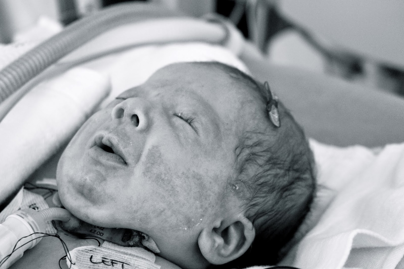 Surgery Tracheostomy & GTube Dear Annie