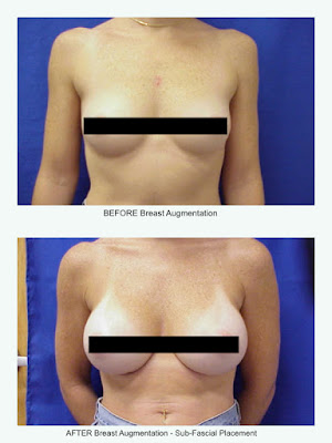 silicone nos seios antes e depois silicone nos seios antes e depois
