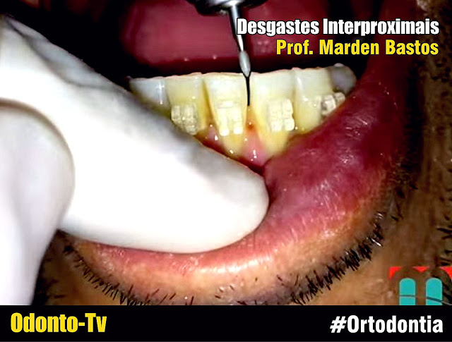 ORTODONTIA: Desgastes Interproximais - Prof. Marden Bastos