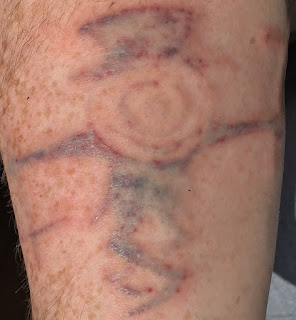 Tattoo after laser session Tattoo 60 minutes after Picosure removal session