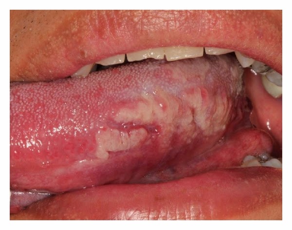placa mucosa sifilis placa mucosa sifilis