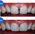 Ngyên nhân răng thưa do gì và phương pháp điều trị ra sao?