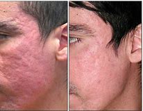 Cuantas Sesiones De Luz Pulsada Se Necesitan 2025