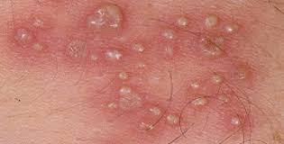 Foto Obat tradisional sembuhkan Herpes Pada Alat Kelamin Paling Ampuh