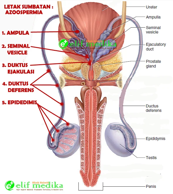 Elifmedika.com : Beberapa kemungkinan letak obstruksi atau sumbatan saluran sperma.