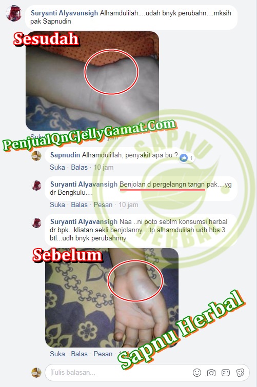 Cara Mengobati Benjolan Di Kaki Kanan dan Kiri Secara Alami Sampai Tuntas ~ TESTIMONI QNC JELLY GAMAT Cara Mengobati Benjolan Di Kaki Kanan dan Kiri Secara Alami Sampai Tuntas ~ TESTIMONI QNC JELLY GAMAT