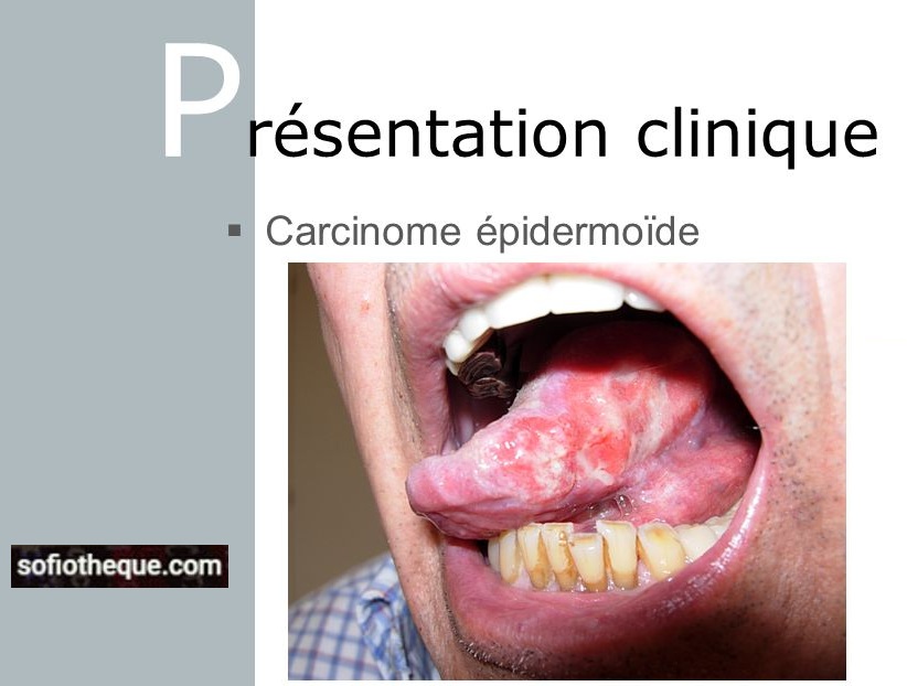 Carcinome épidermoïde De La Langue
