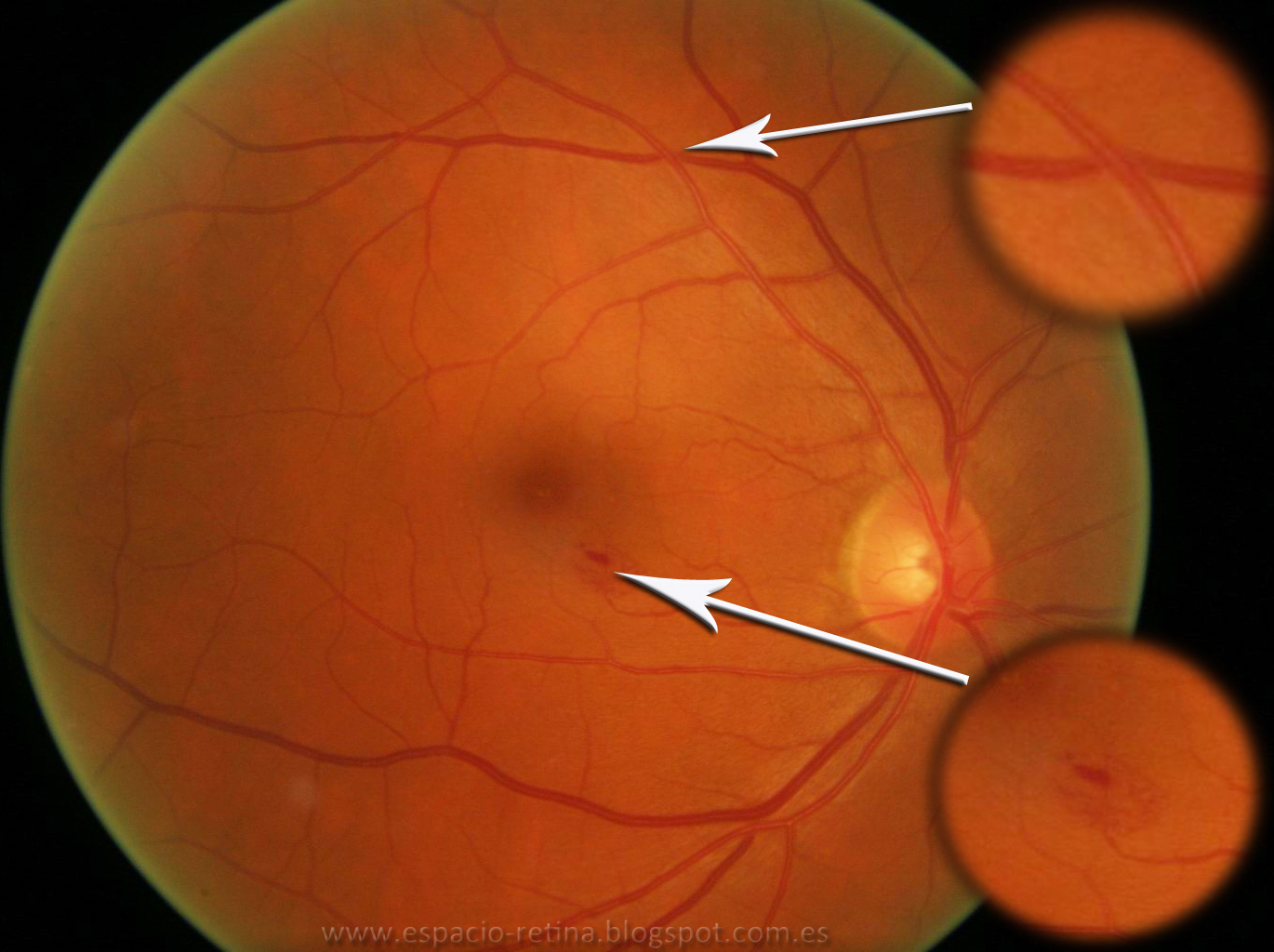ESPACIO RETINA Retinopatía HTA. ESPACIO RETINA Retinopatía HTA.