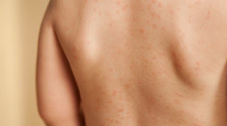 skin rashes viral