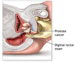 modula trata inflamația prostatei glandei