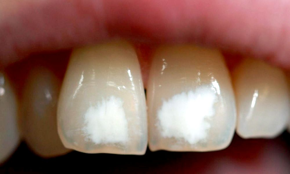 Fluorose Dentária