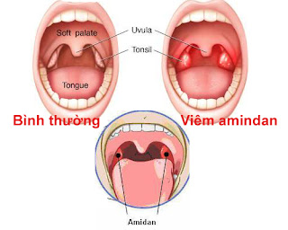Điều trị viêm amidan bằng cây đinh lăng Điều trị viêm amidan bằng cây đinh lăng