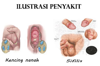 Tips cara ampuh mengobati kencing sakit keluar nanah sembuh total