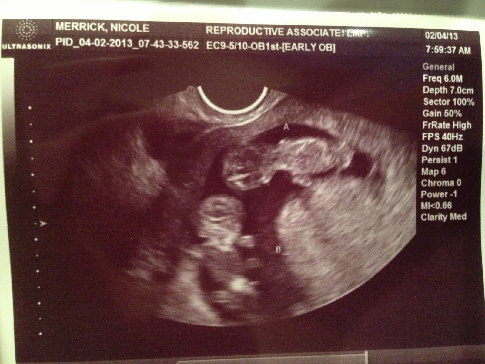 10 Weeks Pregnant Ultrasound Twins