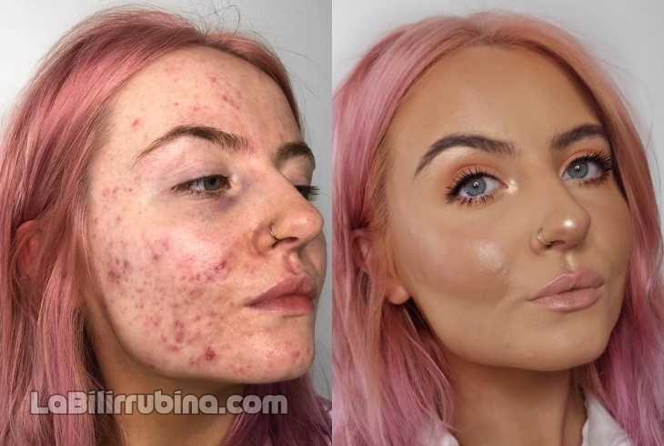 Ella sufre de acné quístico severo y su base de maquillaje se ha hecho viral Abbie Bull