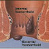 WASIR INTERNAL DAN WASIR EKSTERAL thumbnail