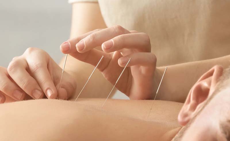 5 Unexpected Acupuncture Side Effects That Are Actually Part of the Healing Process