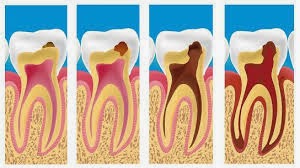 Cara Tradisional Mengobati Sakit Gigi Berlubang Dengan Cepat