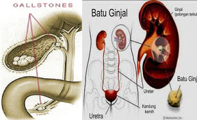 cara menghancurkan batu ginjal tanpa operasi,obat batu ginjal,obat kencing batu,cara mengeluarkan batu ginjal tanpa operasi,cara menghilangkan batu ginjal tanpa operasi