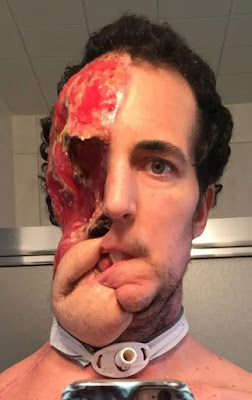 B Man who lost half his face to melon-size cancerous tumour gets Terminator-style transplant built by genius surgeon (graphic photos)