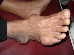 Tanda Sakit Asam Urat Atau Gout Tanda Sakit Asam Urat Atau Gout