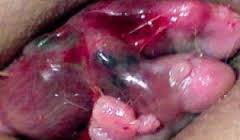 Foto BAB BERDARAH MINUM OBAT APA YANG MUJARAB