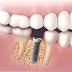 Cấy ghép răng implant như thế nào?
