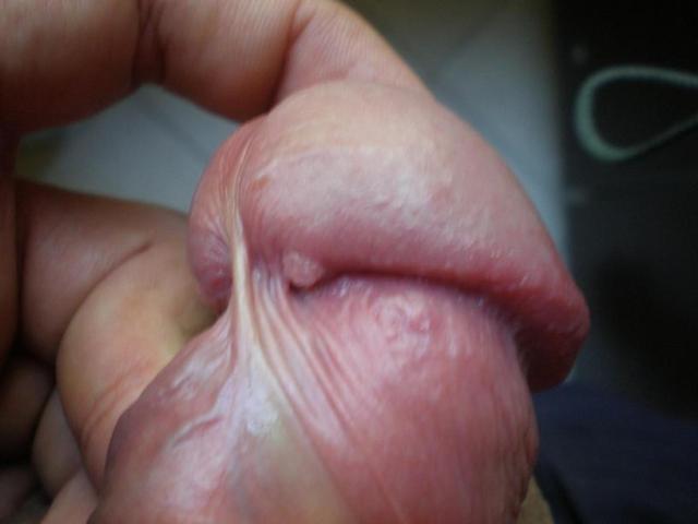 Obat Kutil Jerawat