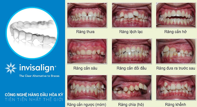 Niềng răng Invisalign