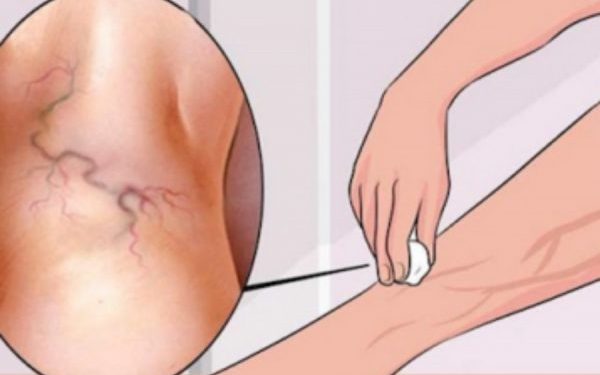 Here's How To Eliminate Varicose Veins With This Granny Remedy
