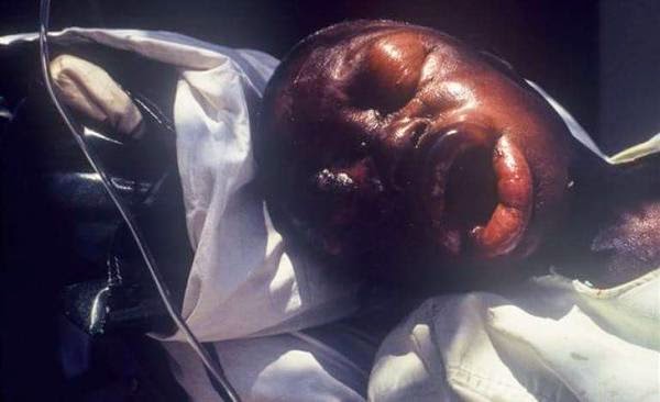 Victims of deadly disease at Irele Ondo State Nigeria