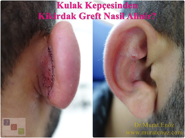 Auricular Cartilage (Pinna Cartilage) Graft in Revision Rhinoplasty - Why auricle cartilage graft is needed in revision rhinoplasty operations? - When auricle cartilage graft is used in revision nose job surgeries? - How to taken the cartilage graft from the auricle (auricular conchal cartilage)? - Recommendations after the cartilage graft taken from the auricle  - Does the shape of the auricle change after the cartilage graft taken from the auricle? - Why is a cartilage graft removed from the auricle? - In which cases is the cartilage graft used from the auricle? - Use of cartilage graft taken from the ear for revision nose aesthetic - Cartilage graft taken from the auricle - What to do after taken of the cartilage graft from the auricle? - Auriculer conchal cartilage - Use of auricular conchal cartilage in nose aesthetic surgery