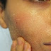 Pimple Treatment by Dr Khurram Musheer