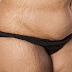 Get Rid of Stretch Marks Fast Home Remedy