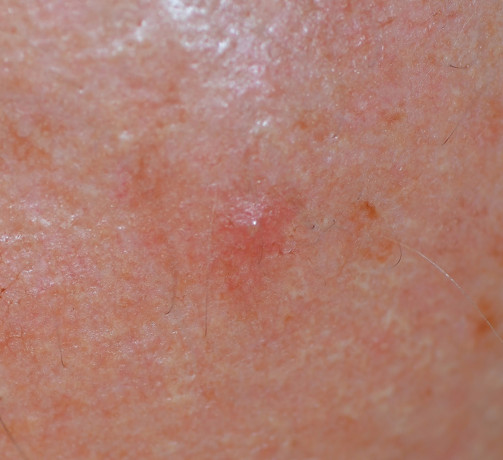 Dermnet: Dermatology Pictures - Skin Disease Pictures