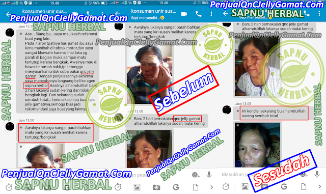 Cara Cepat Menghilangkan Keloid Di Wajah Secara Alami Cara Cepat Menghilangkan Keloid Di Wajah Secara Alami