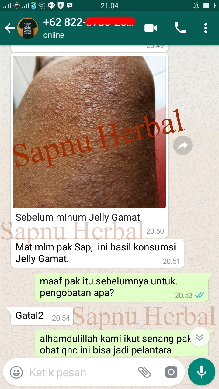 obat kulit gatal kering bersisik menebal dan berkerak obat kulit gatal kering bersisik menebal dan berkerak