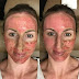Famosas puncionam agulhas em seu rosto para rejuvenescimento!Teria coragem?
