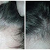 Thin and Bald Hair Magic!!! Grow Your Hair Fast Overnight With Only 1 Ingredients