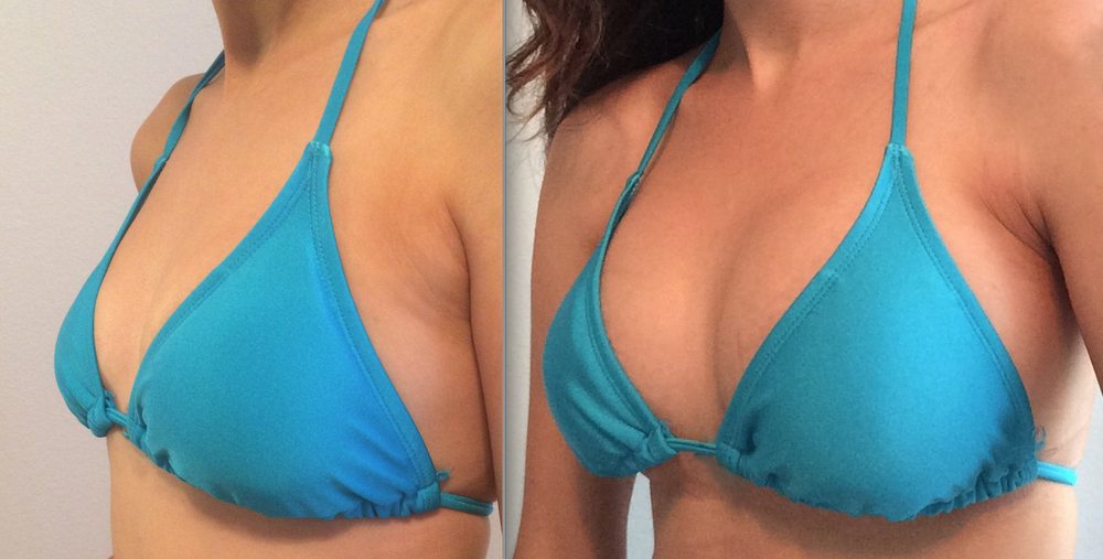 Breast Enhancement Fat Transfer Risks Porn Pics Sex Photos Xxx Images