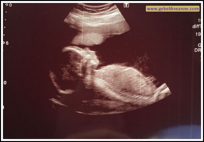 20 Haftalık Gebelik (Hamilelik) Ultrason Görüntüleri