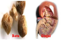 Foto Pengobatan batu ginjal