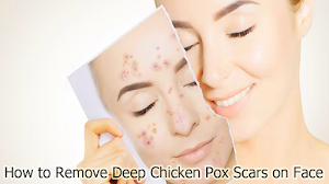 How to Remove Deep Chicken Pox Scars on Face How to Remove Deep Chicken Pox Scars on Face