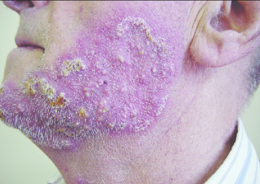 PENYAKIT DERMATOFITOSIS, JENIS, GEJALA DAN PENGOBATAN - WAWASANKU