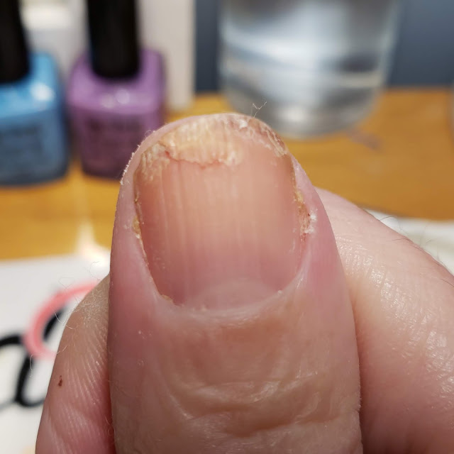broken nail gel fix, nail torn, dry brittle nails