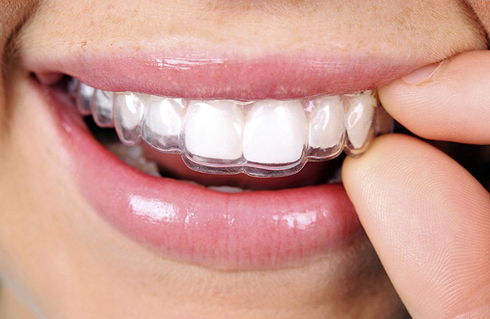How do Invisalign braces work? Directorio Odontológico